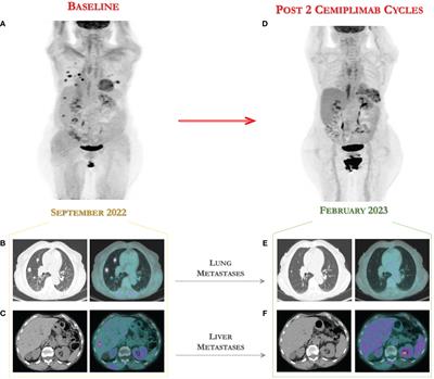 Complete and early response to cemiplimab associated to severe immune toxicity in advanced cervical cancer: a case report